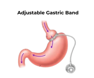 Weight Loss surgery Islamabad