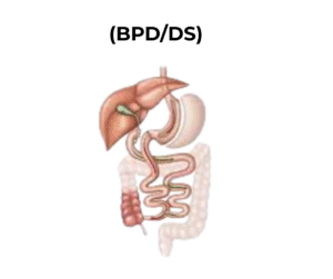 Bariatric surgery Islamabad