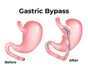 Bariatric Surgery Procedures by Dr. Mukhtar Khan