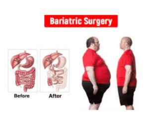 Weight Loss surgery Islamabad