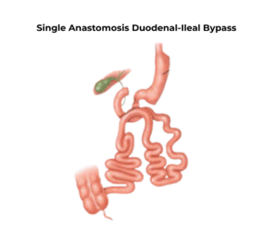 Weight Loss surgery Islamabad