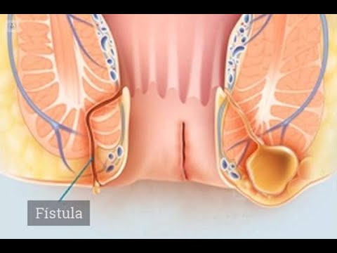 Fissure and Fistula Treatment