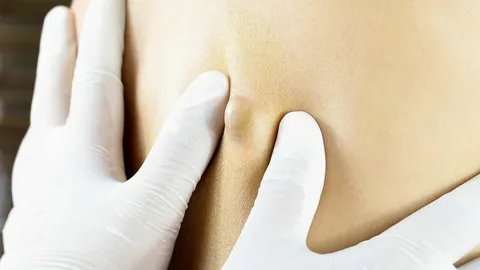 Lipoma Removal treatment in Islamabad